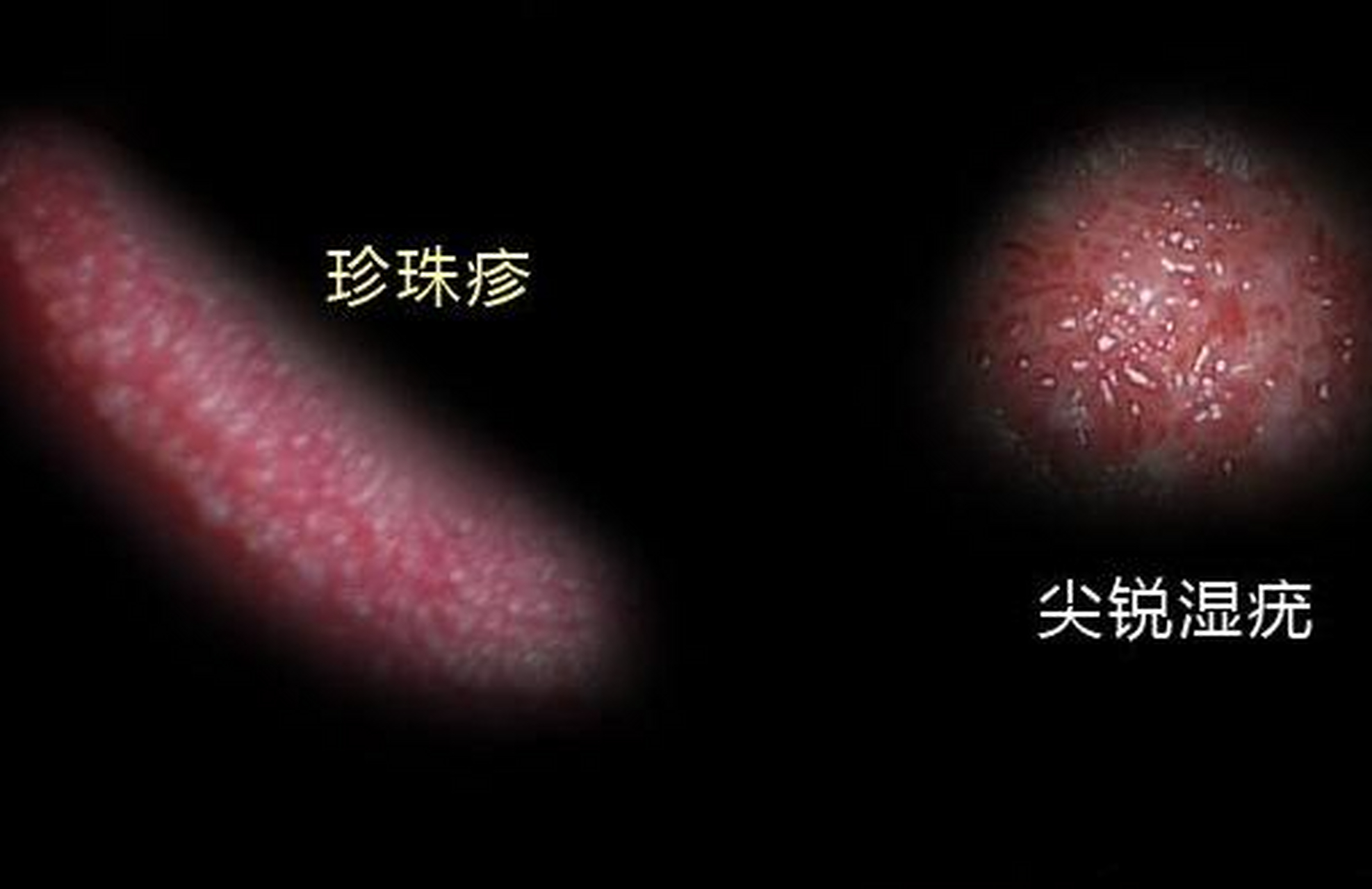 住他各种纠缠就同意了,结果我发现他那里长了好多白色的珍珠状的疹子