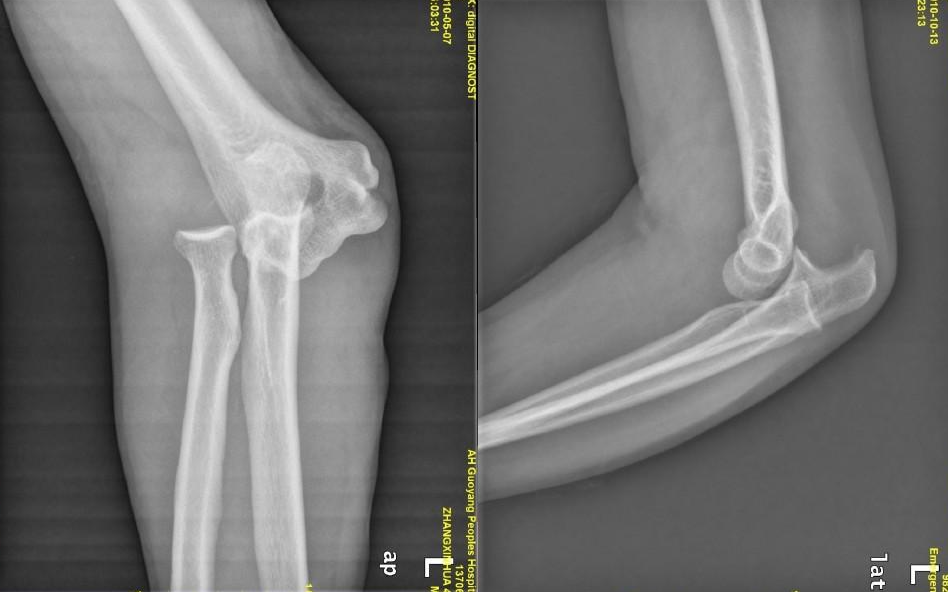 孟氏骨折的不同类型,基本都是外力导致的损伤,发病的人群也不同