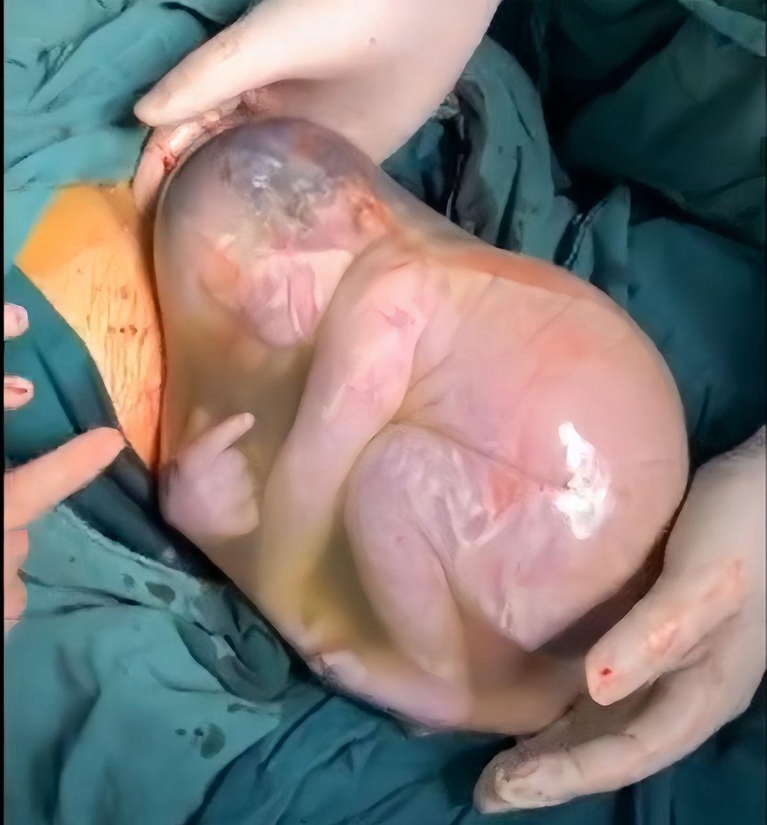 孕妇分娩生出一个"球",丈夫脸色一下变得不好看,医生却道恭喜