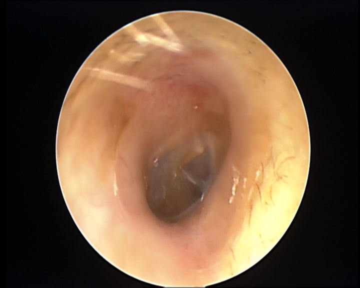 热点|小伙享受了次掏耳朵服务,可怕一幕出现! 耳朵里面竟“发霉”了