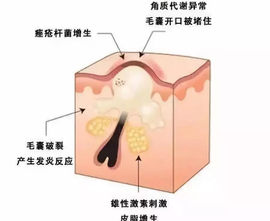 治痤瘡要花多少錢?激光去痘痘效果好嗎?恢復週期長嗎?