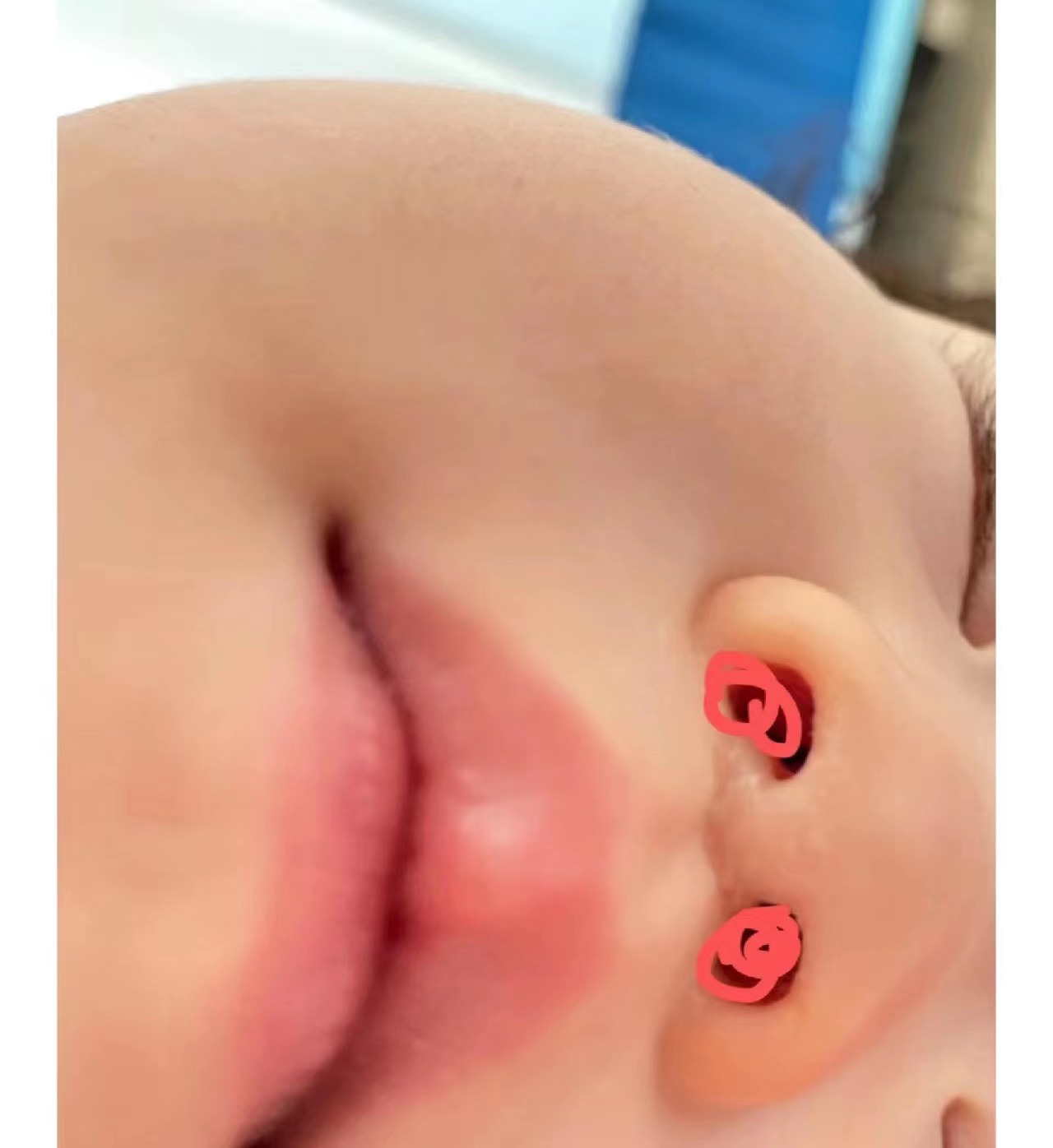 宝宝鼻腔内鼻甲肿大图图片