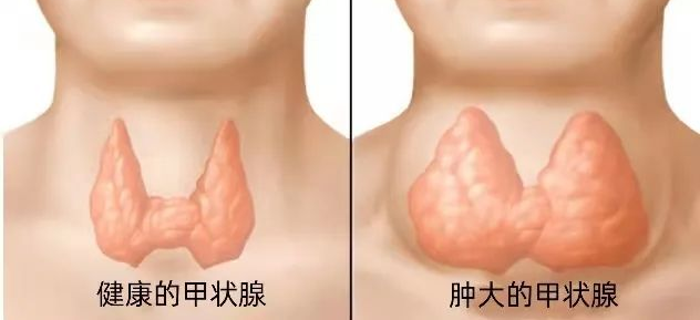 甲状腺肿是什么意思图片