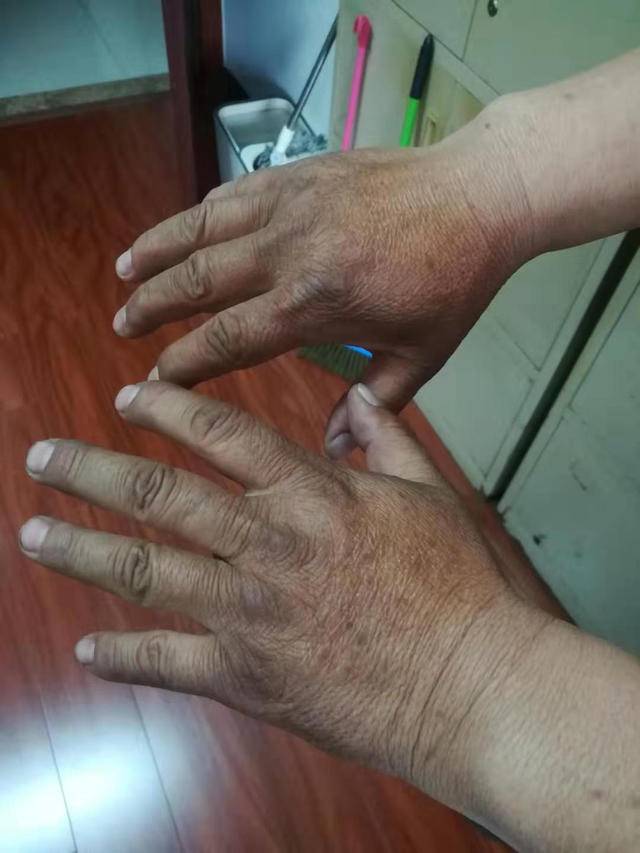 辅警被晒黑的双手