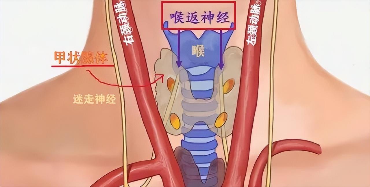 新技术!河南省省肿瘤医院专家巧破复杂甲状腺癌术后失声难题