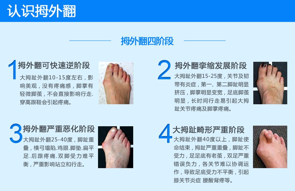 上海健桥医院拇外翻侯明主任:脚骨拐突出是怎么回事