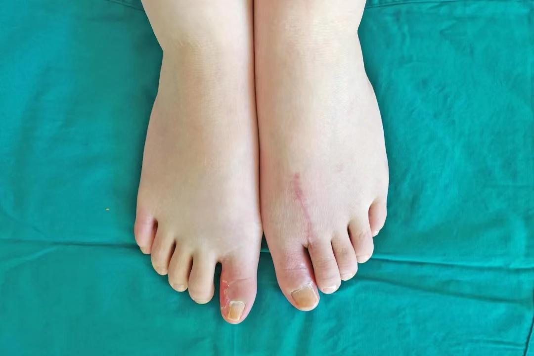 「全国手指再造医院排名」可以保留脚趾的手指再造方法_佛山手指再造