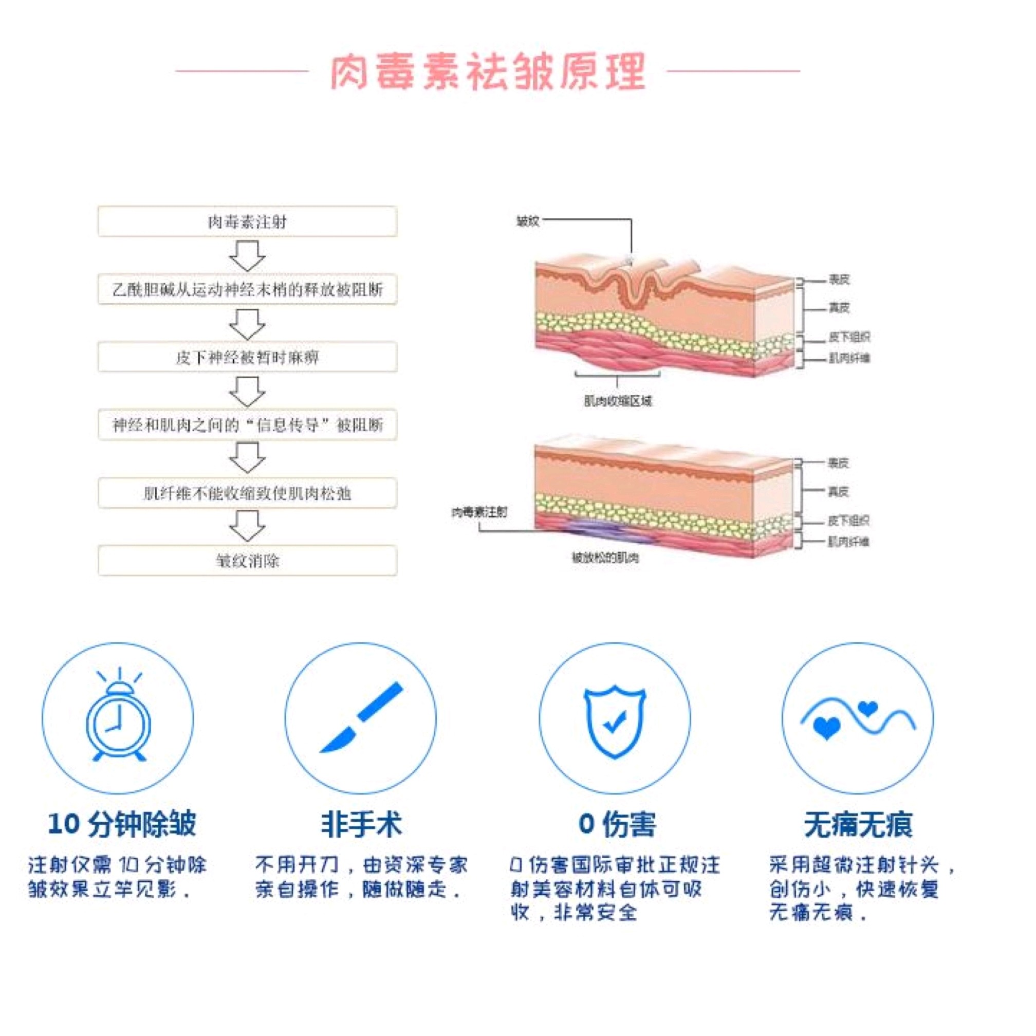 肉毒素注射方法图片