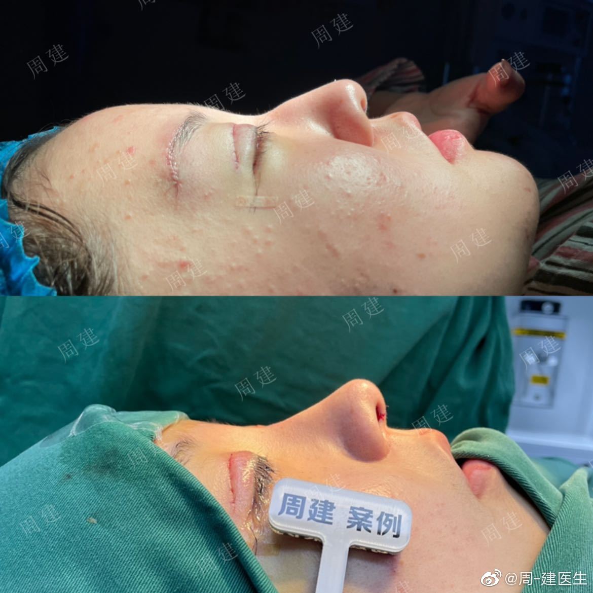 哑铃鼻基底,新术式不移位,郑州周建医生鼻整形专访