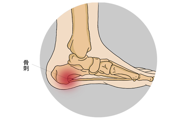 脚后跟疼是什么原因?医生:别再忍着了,这3招帮你远离
