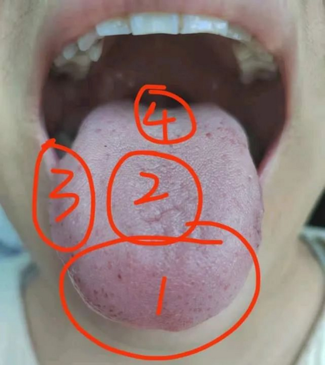 舌像分析:头昏沉  这个舌像舌质比较白微紫,舌苔微厚,舌中凹陷线舌前