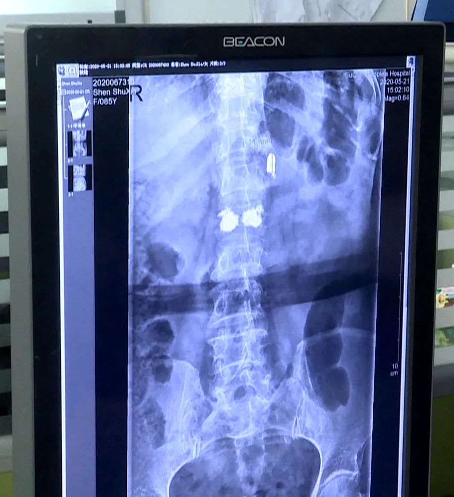 子弹铁证!85岁老人体内发现80年前日军子弹!这是一个年代的悲剧