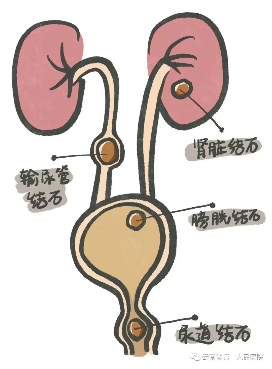 输尿管结石卡通图片图片