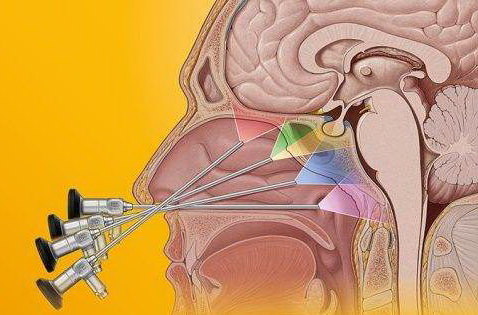 经鼻蝶垂体瘤手术步骤图片
