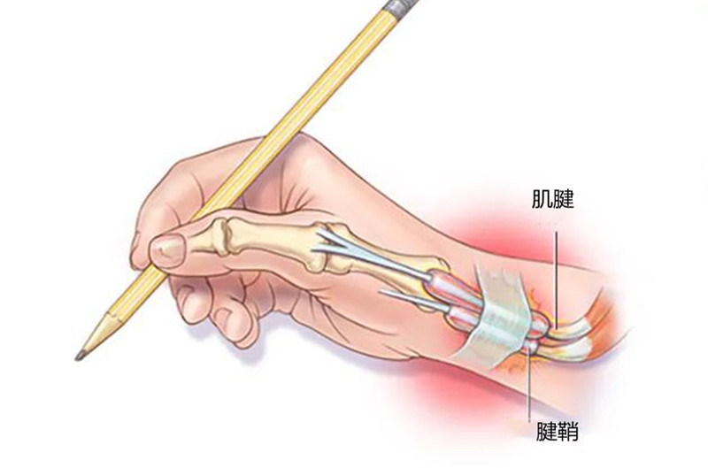 拇指和手腕疼痛,捏不住東西,容易被忽視的狹窄性腱鞘炎