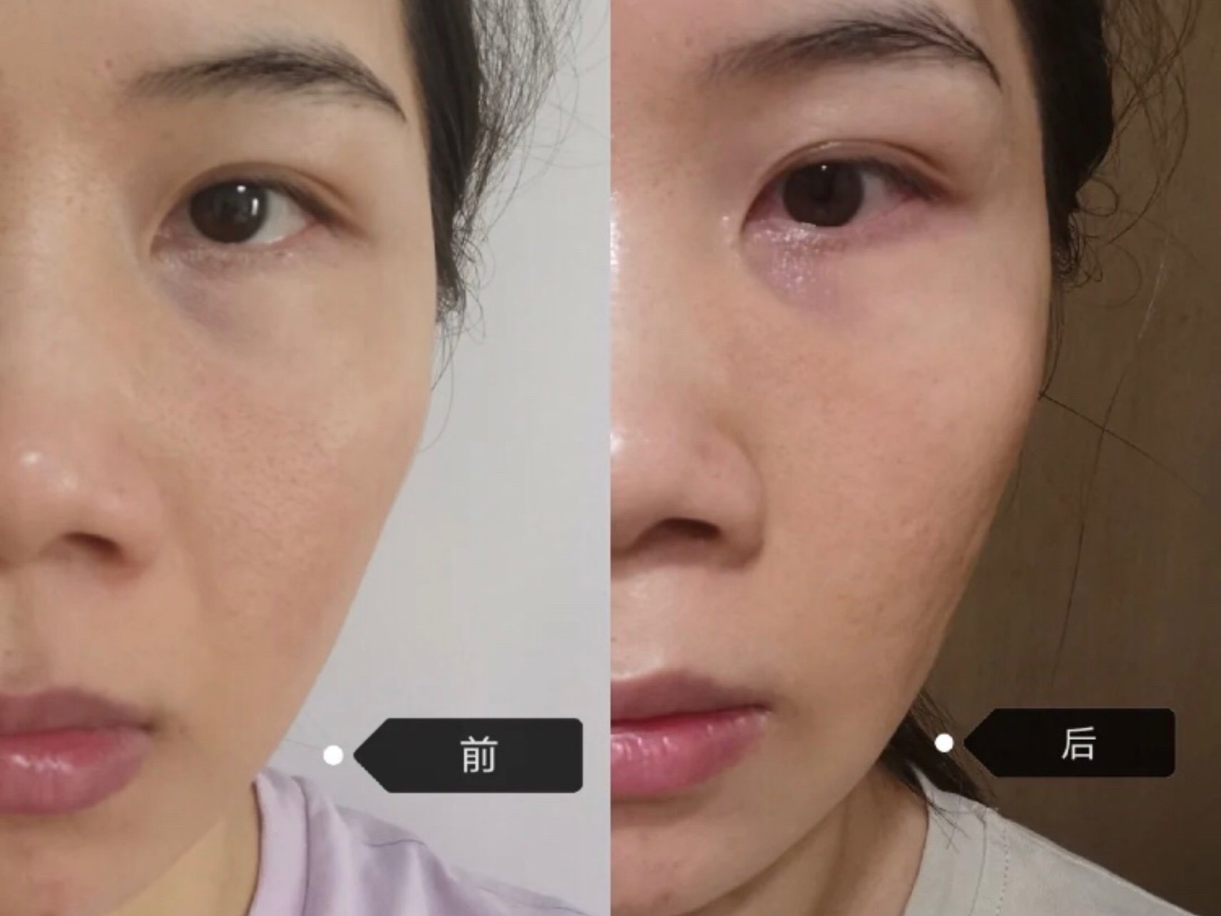 激光治疗时间与效果密切相关,安全可靠,对治疗部位要求很高