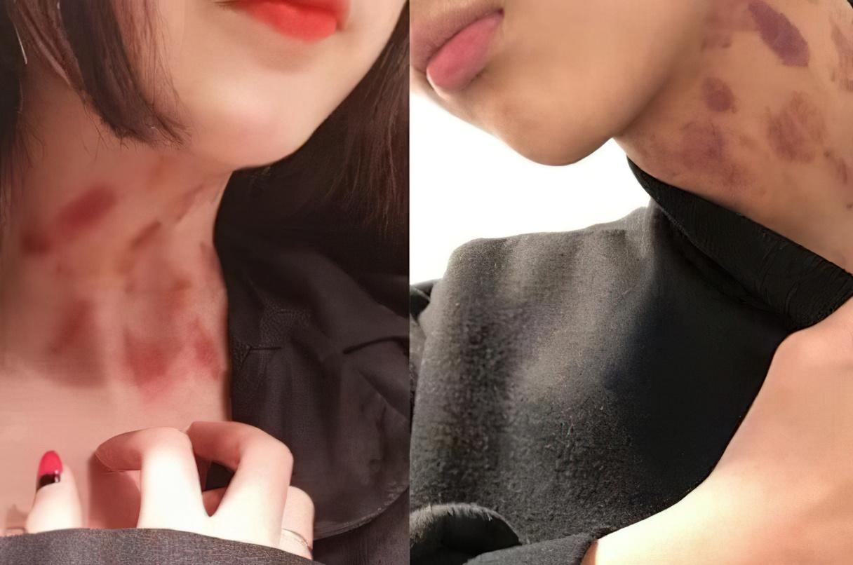 回顾:情侣同居后做了4个姿势,险些丧命,医生:种草莓可能会致命