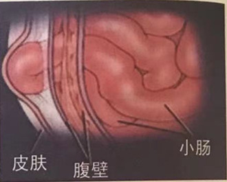 脐肠瘘症状图片图片