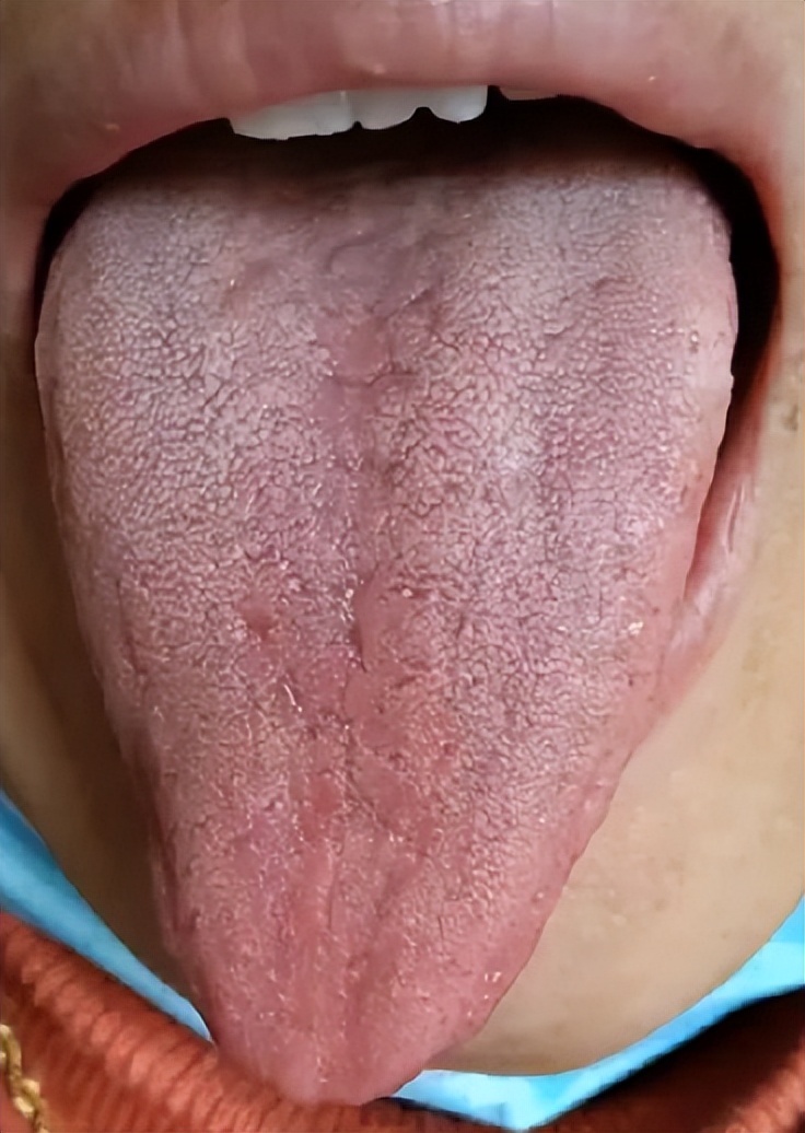 典型的三角舌!歪斜 阴血不足,可能是中风的先兆了