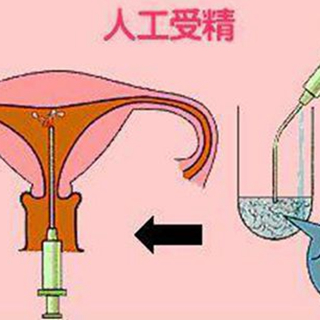 人工授精疼不疼女性图片