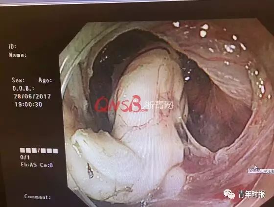 推荐|小伙明明很饿却食难下咽，原来食管深处竟有只“小狗”！医生：罕见