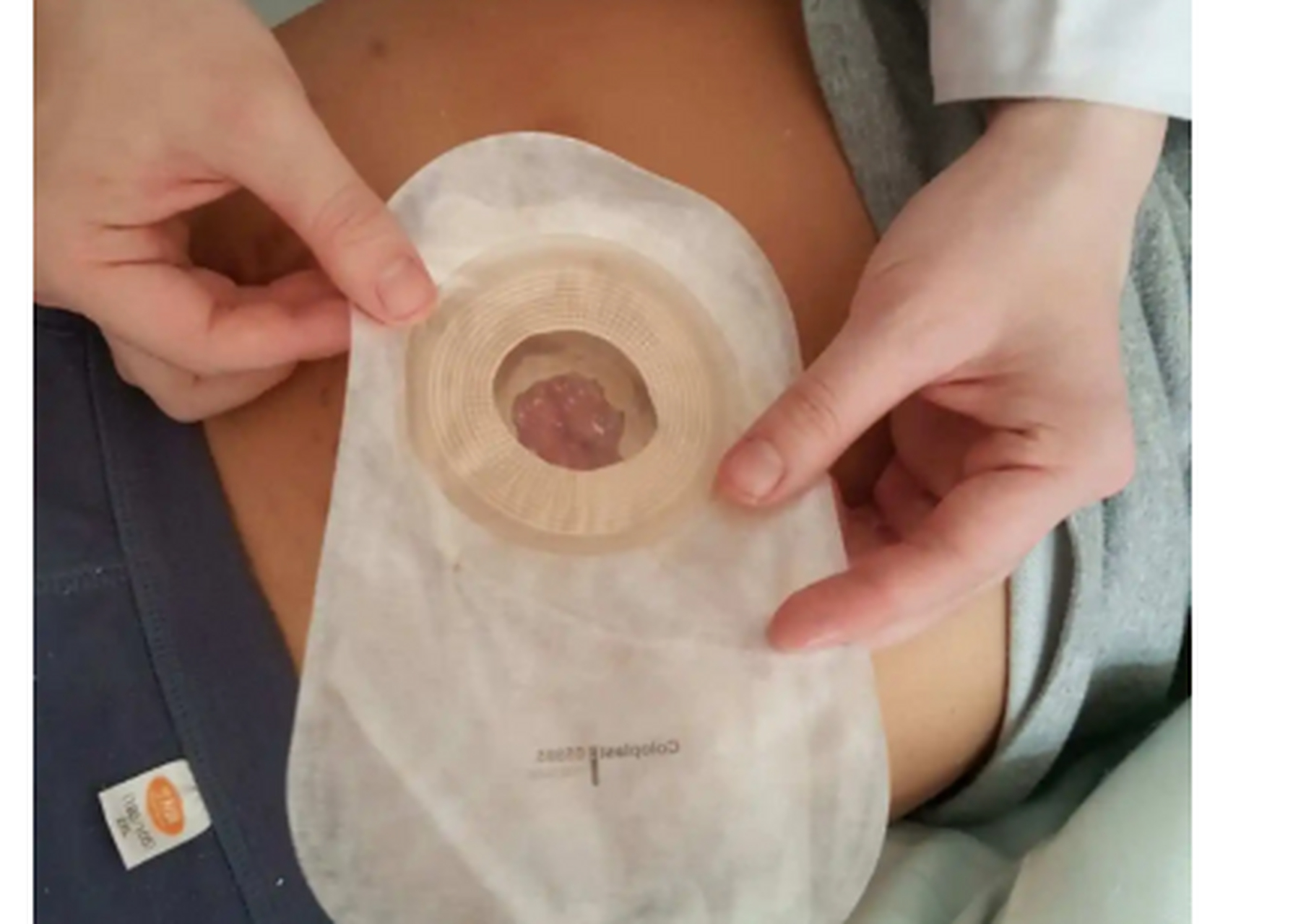 好恶心呀,我不想再换粪袋了,我爸爸直肠癌切除了肛门之后做了造口,这