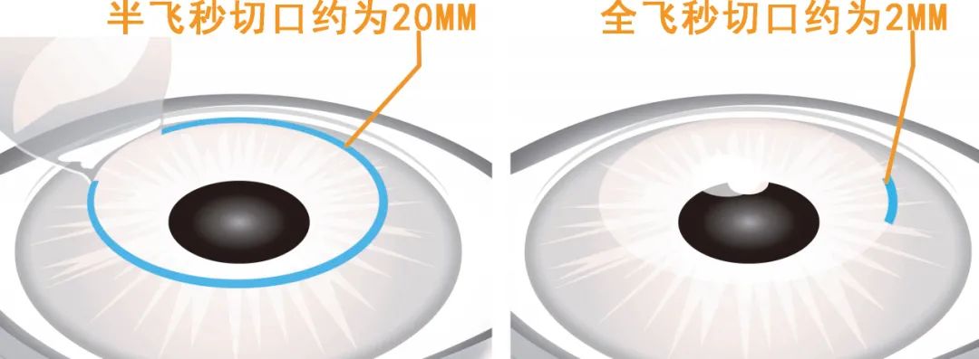 全飞秒和半飞秒怎么选择?满满干货!