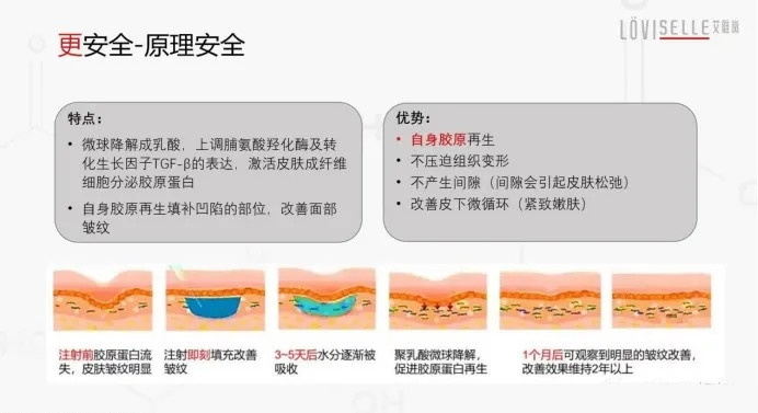 艾维岚童颜针注射层次图片