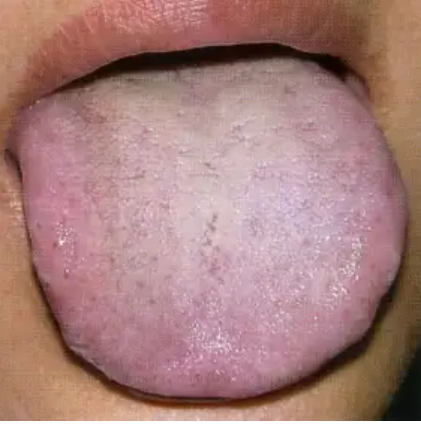 今天分享典型舌象:胖大舌   胖大舌:舌体虚浮胖