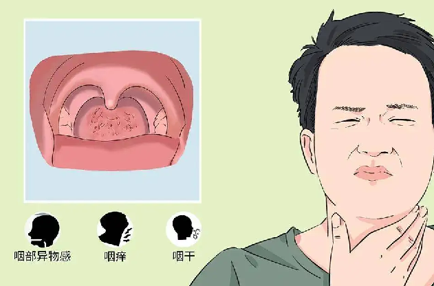 咽干声音嘶哑或咽喉肿痛,一个中成药清热润肺利咽开音