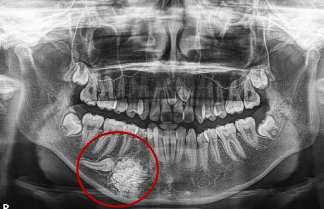 16岁女孩竟长出70多颗"小牙",牙齿还能长肿瘤?