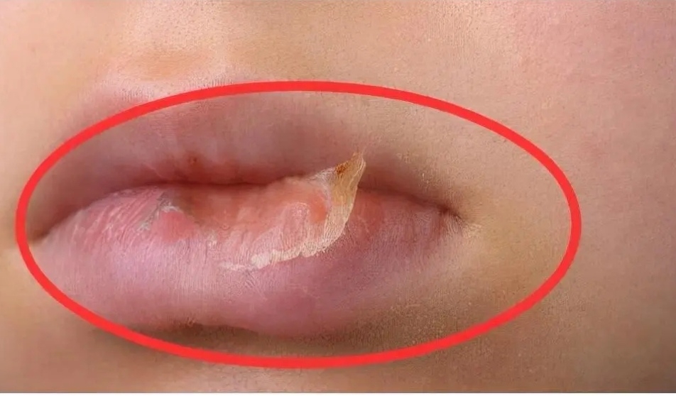 孩子嘴唇干裂出血怎么办?听听儿科医生的建议,妈妈可以学起来