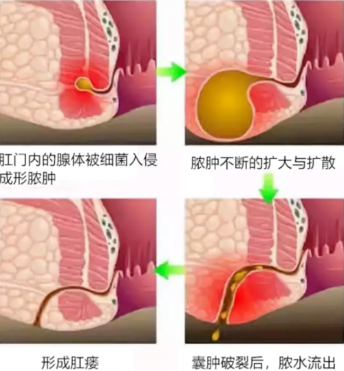 男宝宝肛周脓肿图片图片