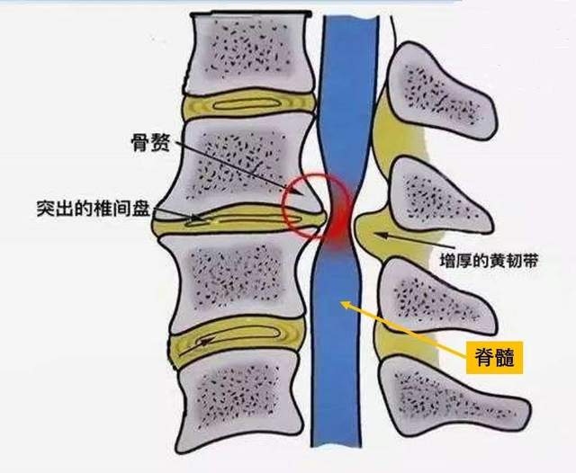 颈椎病导致神经