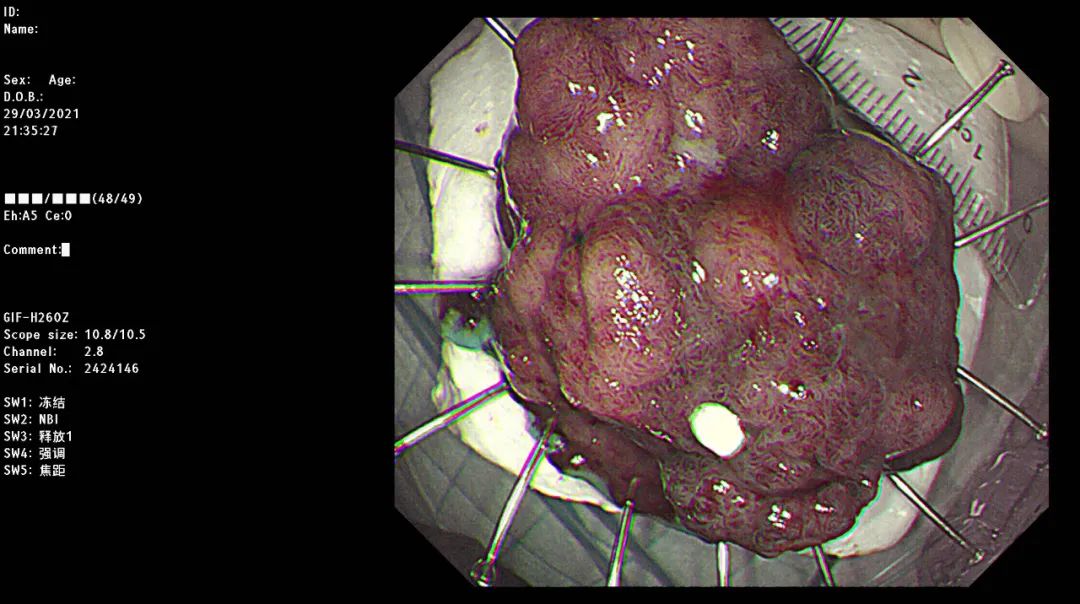 肠道颗粒细胞瘤图片