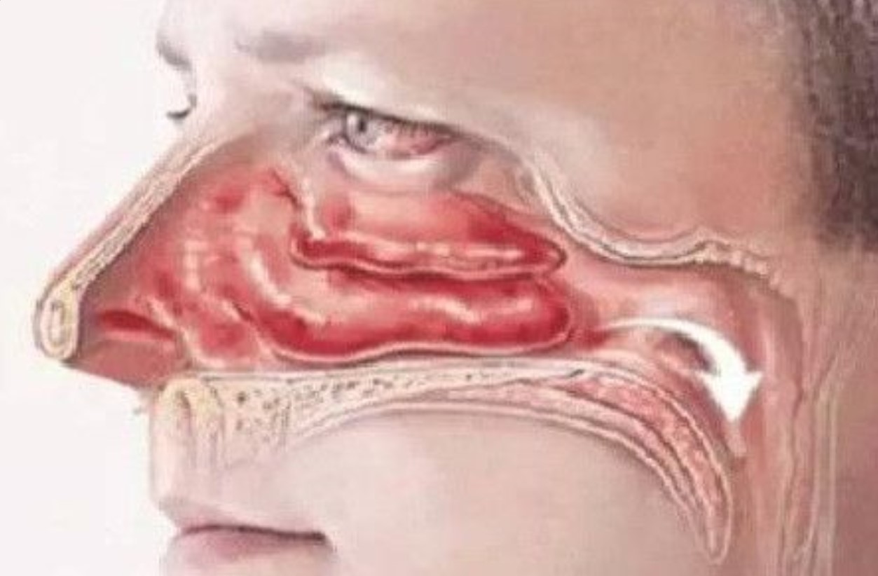 创伤性鼻中隔穿孔,多由头,面,鼻部外伤引起,可能并发嗅觉减退