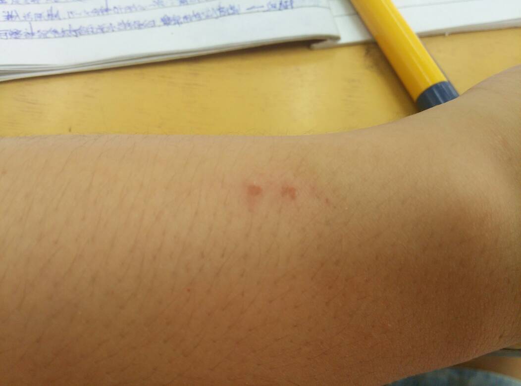 感染艾滋病,还能活多久?如何判断自己是否感染了艾滋病?