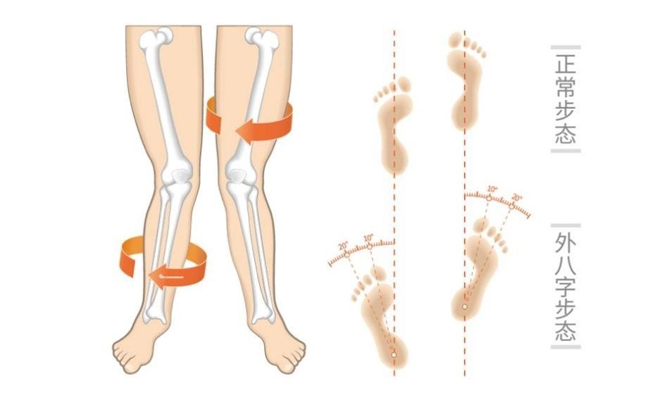 外八字脚如何矫正图片