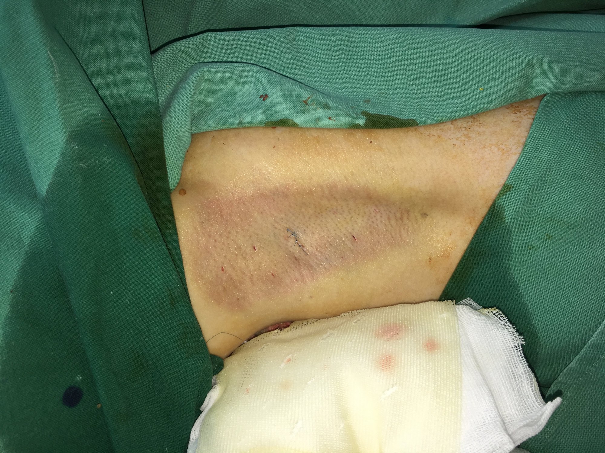 腋臭进行手术切除大汗腺可根治,手术应在青春期后做,会遗传