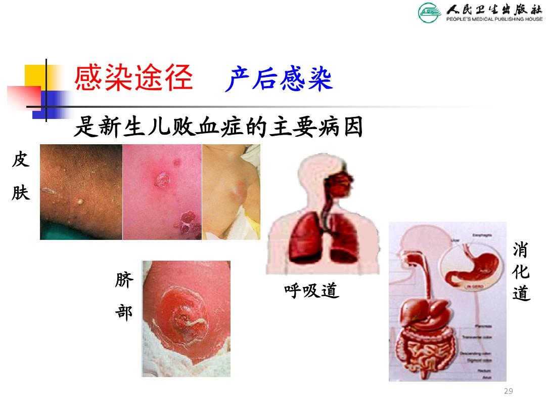 新生儿败血症有怎样的临床表现?这与儿童年龄,抵抗力均相关