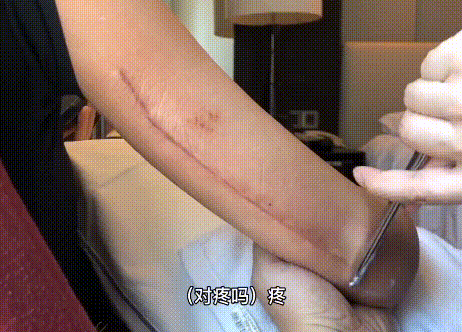 万茜走花路毁誉参半,连车祸都被质疑炒作,伤疤触目惊心