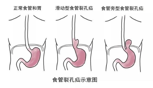 食管裂孔疝是什么病图片