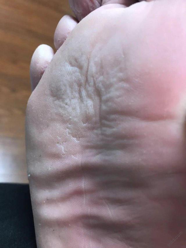 肝脏好的人,脚部可能不会出现这几个表现,大家不妨了解一下