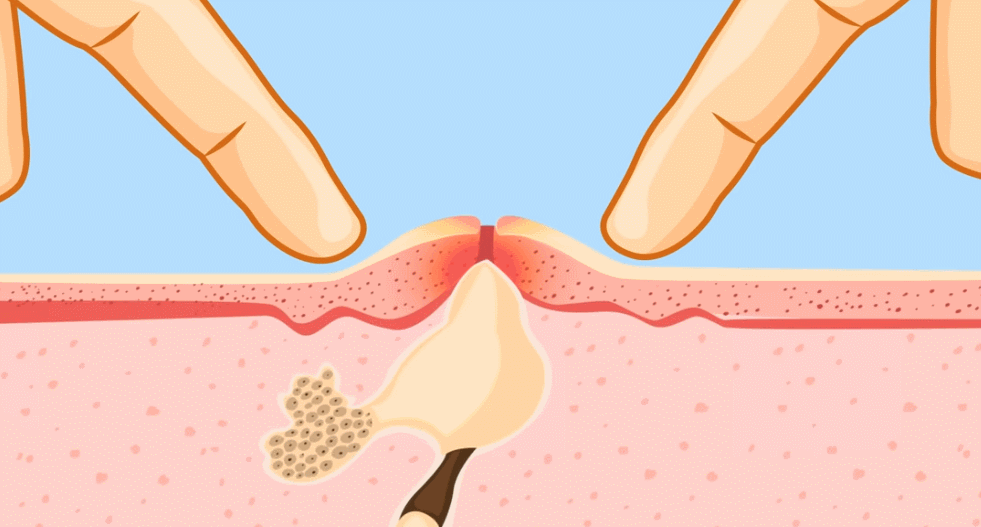 脸上痘痘不要乱挤!当心留下痘疤!重组ⅩⅦ型人源化胶原蛋修复皮肤