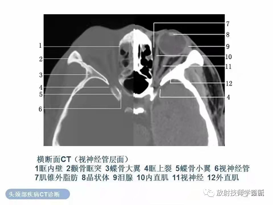 ct眼环的结构图图片