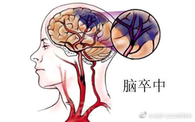 夏季导致脑中风发生的原因有哪些?