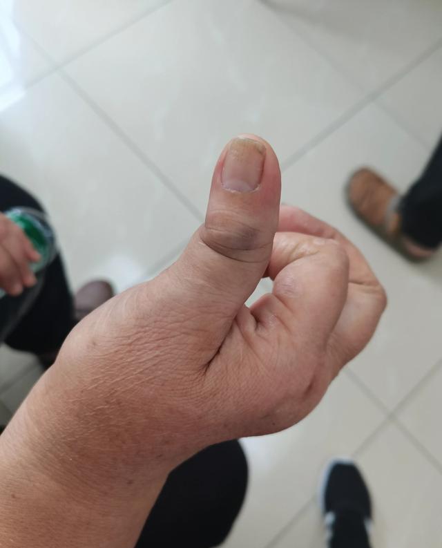 值夜班时来了一个手指脱位的病人,帮她三秒无痛复位