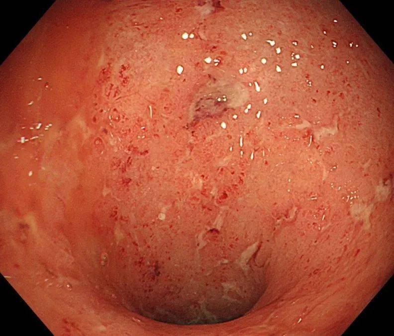 极早发型炎症性肠病是一种怎样的疾病,有什么有效的治疗方法