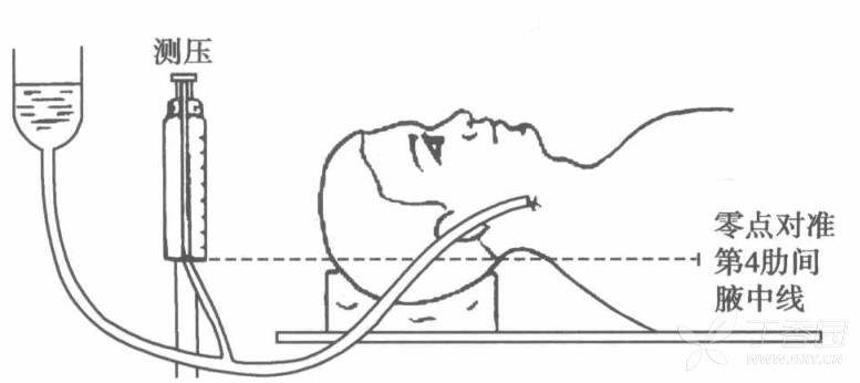 中心静脉压装置示意图图片