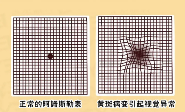 兰州爱尔实用科普|一图自测:你是否有致盲眼病